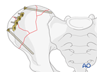 intact posterior arch innominate bone iliac wing fracture