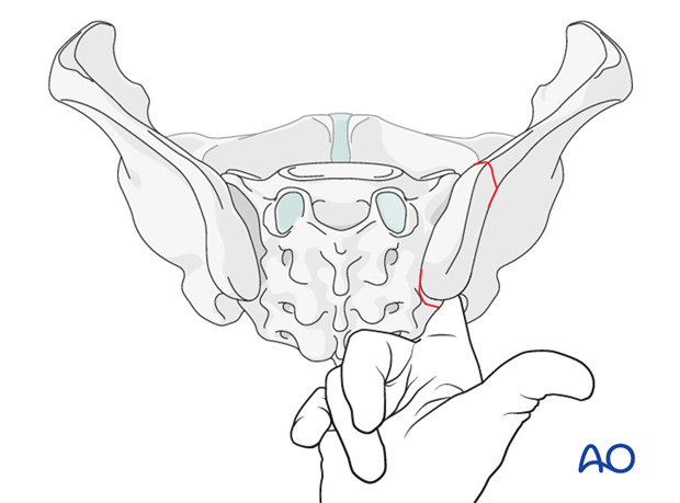 orif posterior si fracture fixation