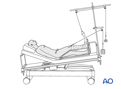 External fixation and traction for Incomplete disruption of posterior ...