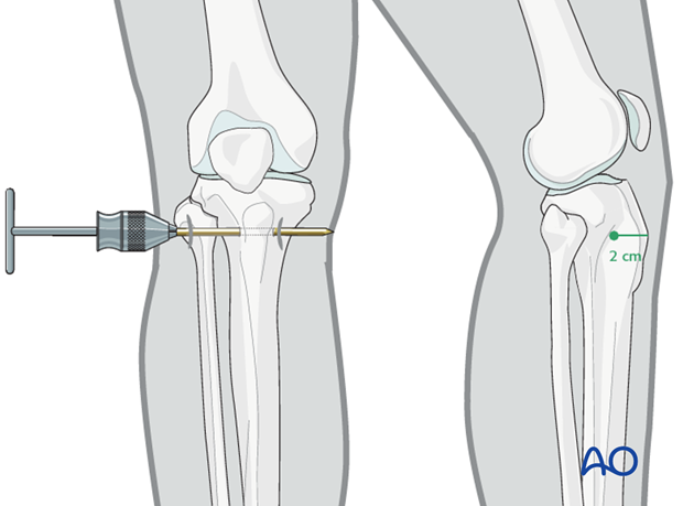 external fixation and traction