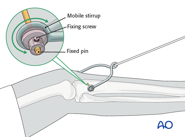 external fixation and traction