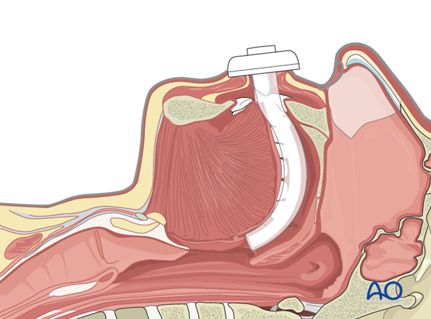 airway