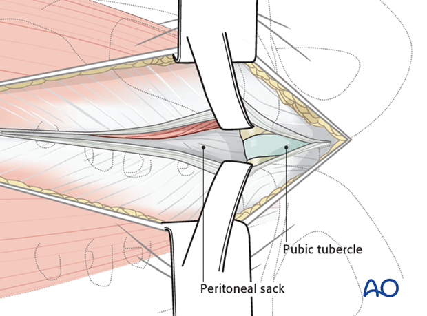 extraperitoneal pelvic packing