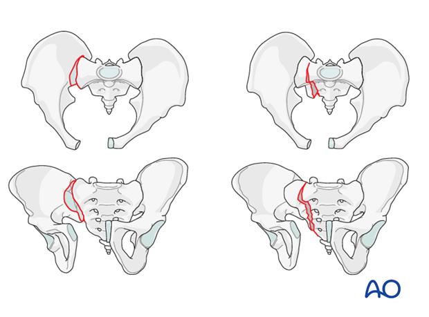 What are open book pelvic fractures?