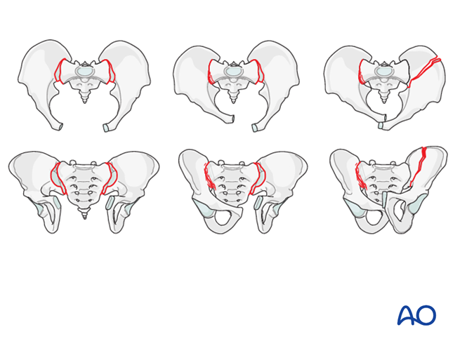 Operative treatment for Incomplete disruption of posterior arch ...