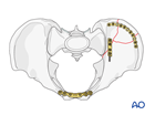 unilateral complete disruption posterior arch through ilium