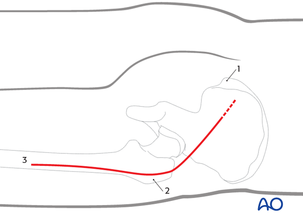 kocher langenbeck approach to the acetabulum