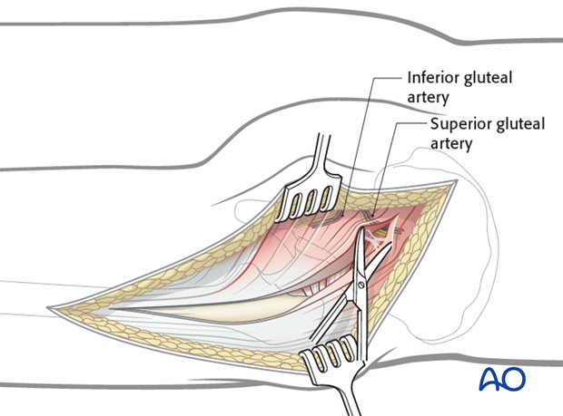 kocher langenbeck approach to the acetabulum