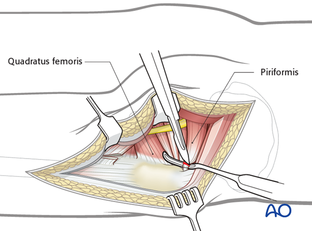 kocher langenbeck approach to the acetabulum