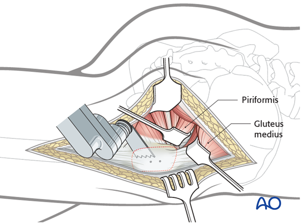 kocher langenbeck approach to the acetabulum