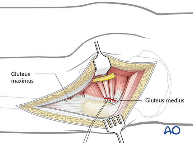 kocher langenbeck approach to the acetabulum