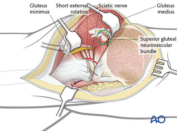 extended iliofemoral approach to the acetabulum