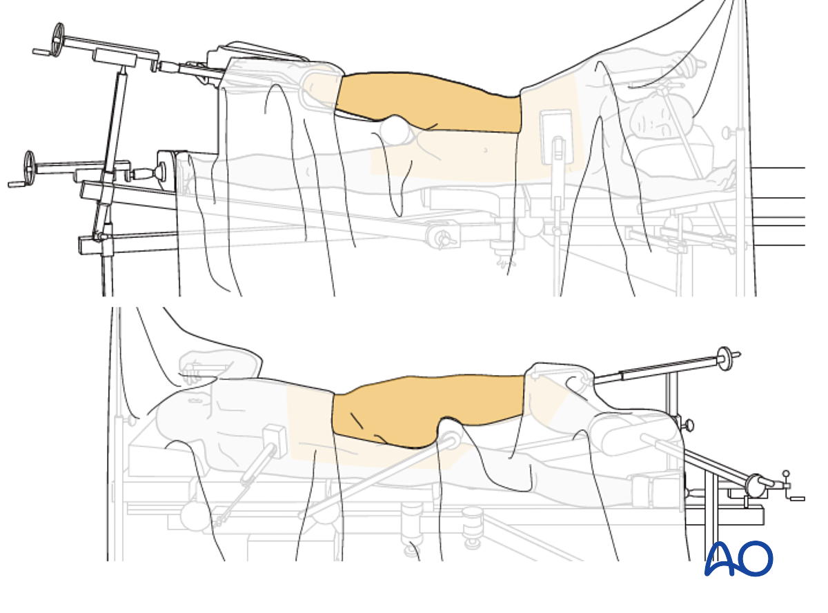 ORIF Through Extended Iliofemoral Approach For Transverse