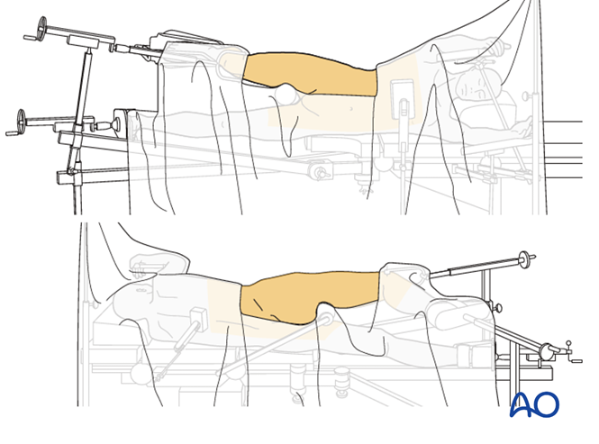 ORIF through extended iliofemoral approach for Transverse