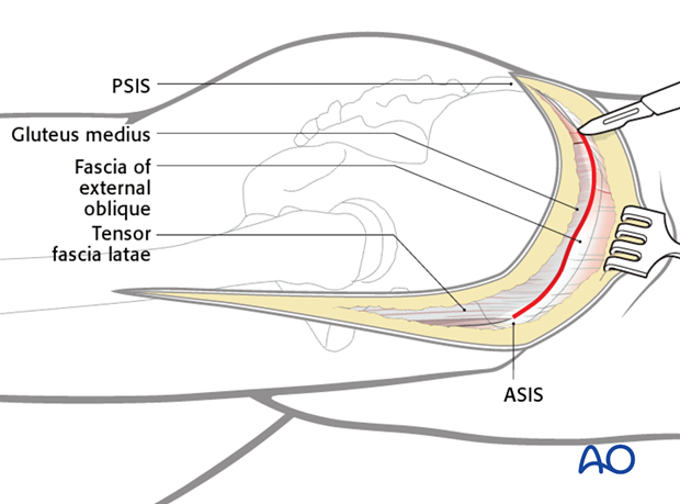 extended iliofemoral approach to the acetabulum