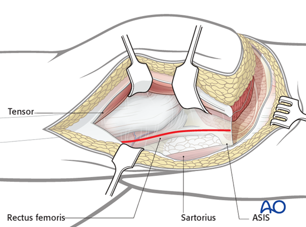 extended iliofemoral approach to the acetabulum