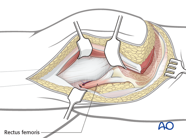 extended iliofemoral approach to the acetabulum