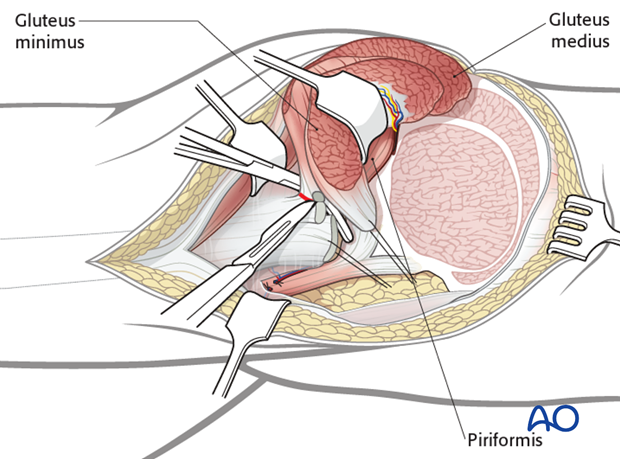 extended iliofemoral approach to the acetabulum