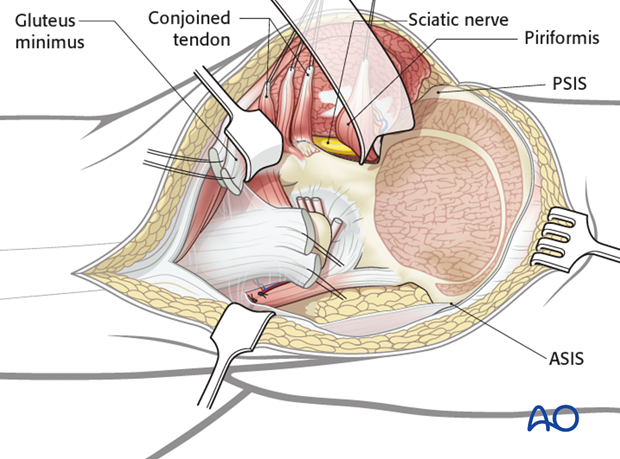 extended iliofemoral approach to the acetabulum