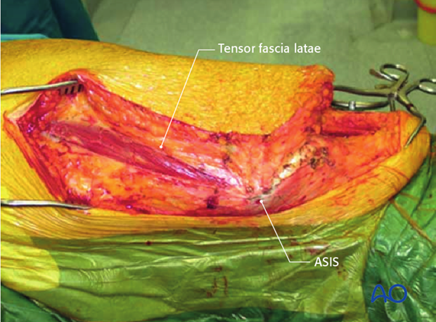 extended iliofemoral approach to the acetabulum