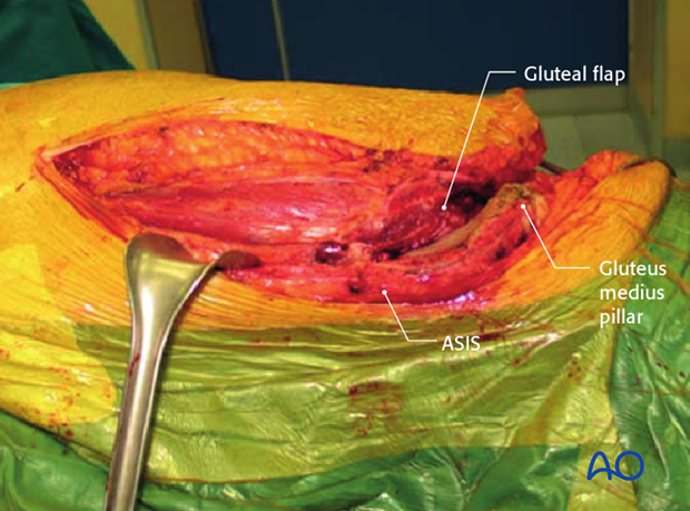 extended iliofemoral approach to the acetabulum