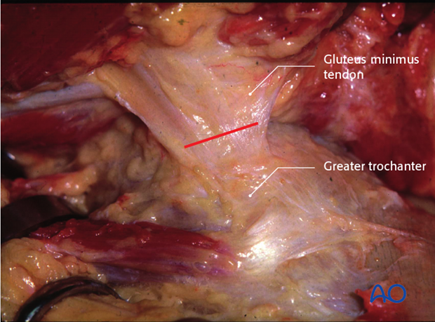 extended iliofemoral approach to the acetabulum