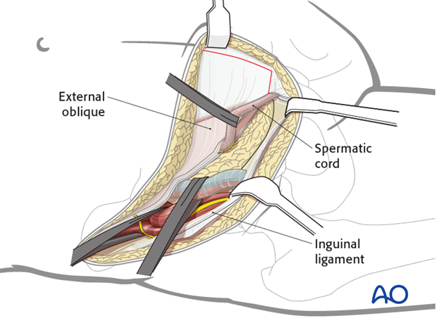 ilioinguinal approach to the acetabulum