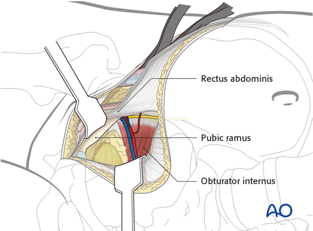 ilioinguinal approach to the acetabulum