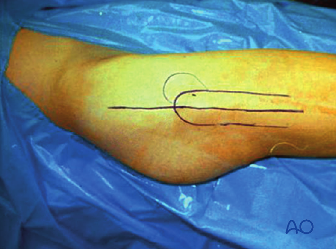 Trochanter osteotomy of the acetabulum