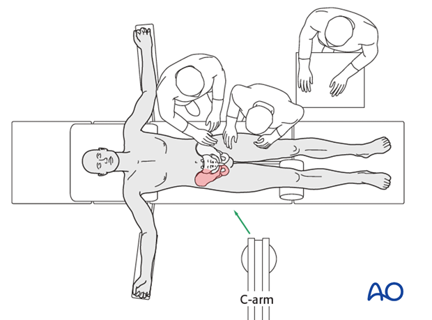 Patient supine on radiolucent table, surgeon opposite fracture, scrub team behind, image intensifier on fracture side, injured leg with bolster under knee.