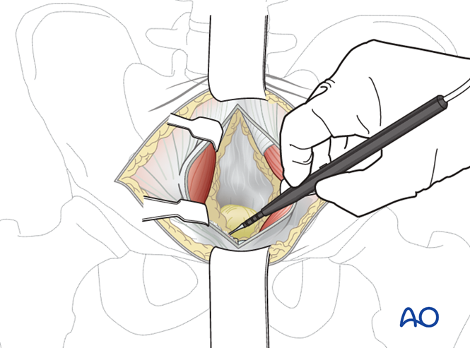 Modified Stoppa approach to the acetabulum