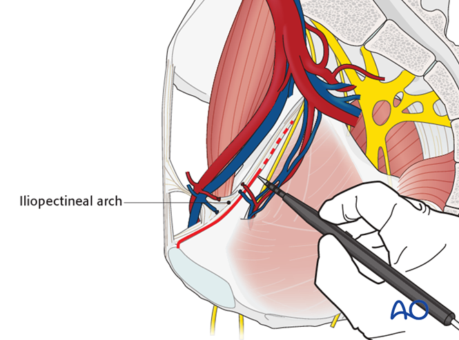 Modified Stoppa approach to the acetabulum