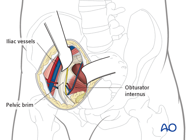 Dissect iliopectineal arch from bone; elevate femoral vessels and nerve; expose internal surface of superior pubic ramus.