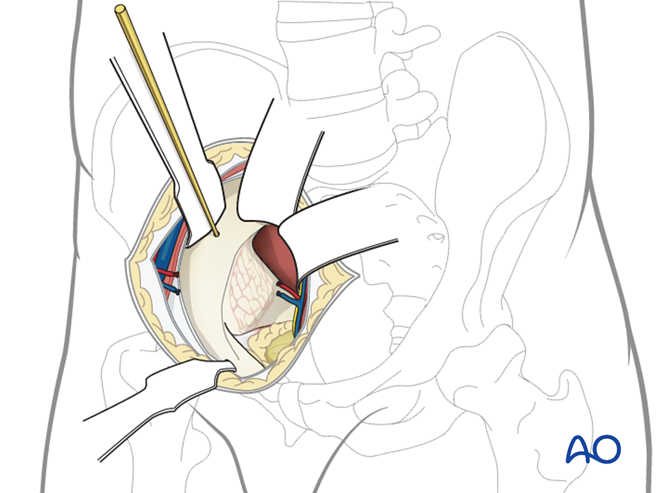 Modified Stoppa approach to the acetabulum