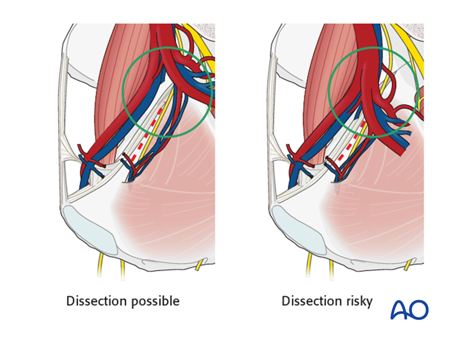 Modified Stoppa approach to the acetabulum