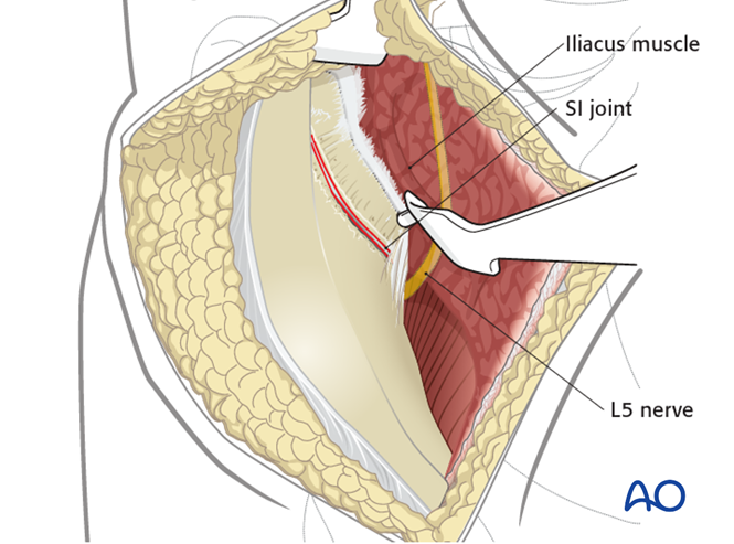 Modified Stoppa approach to the acetabulum