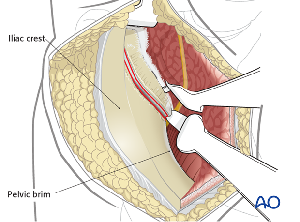 Place Hohmann anterior to SI joint; avoid superior gluteal artery and nerve; expose anterior column to SI joint.