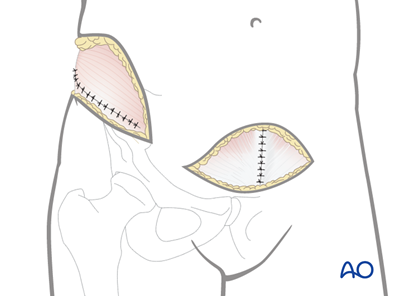 Modified Stoppa approach to the acetabulum