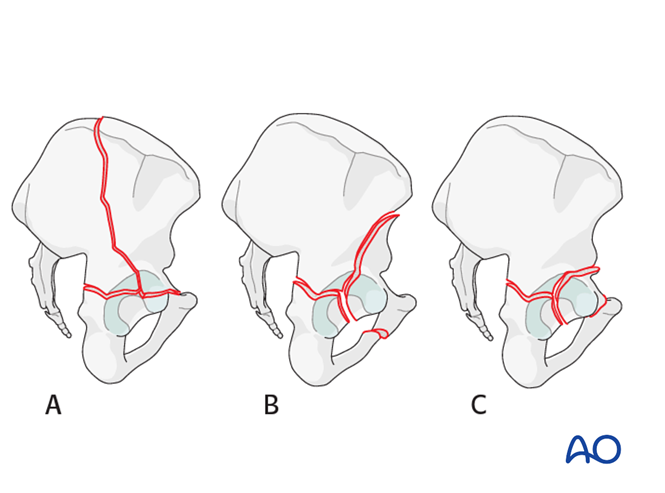 Anterior column and posterior hemitransverse