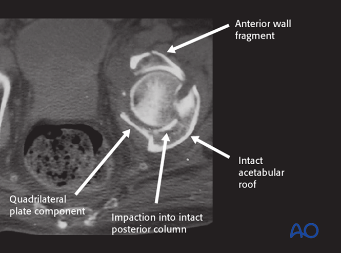 ORIF through modified Stoppa approach for Anterior column