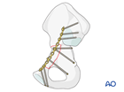anterior wall