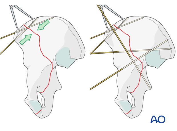 orif through ilioinguinal approach