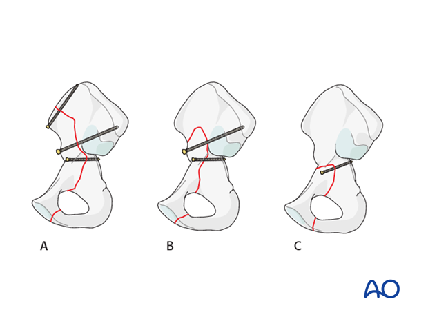 orif through ilioinguinal approach