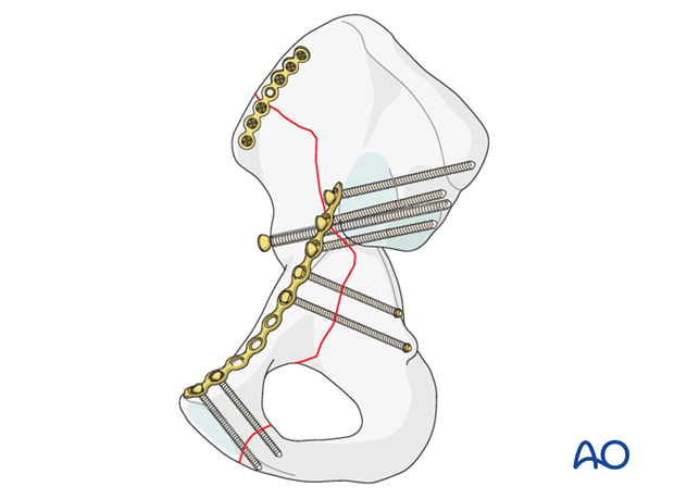 orif through modified stoppa approach