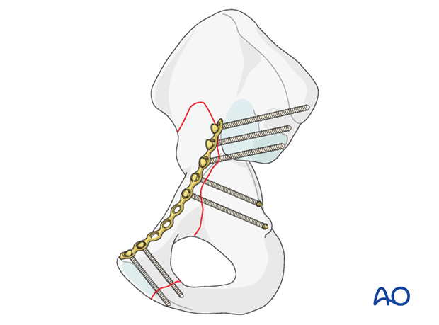 anterior column