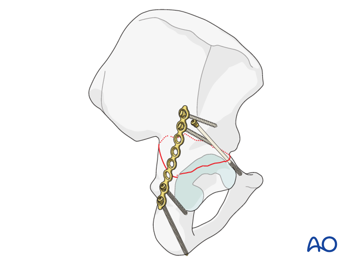 ORIF Through Extended Iliofemoral Approach For Transverse