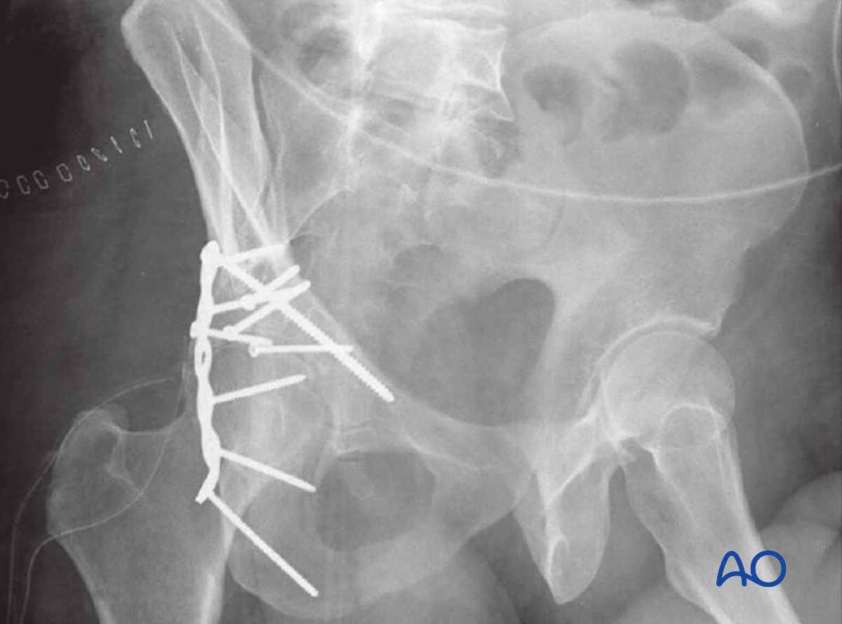 ORIF Through Extended Iliofemoral Approach For Transverse