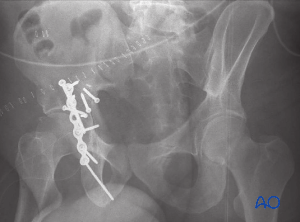 ORIF Through Extended Iliofemoral Approach For Transverse