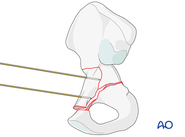 orif through ilioinguinal approach