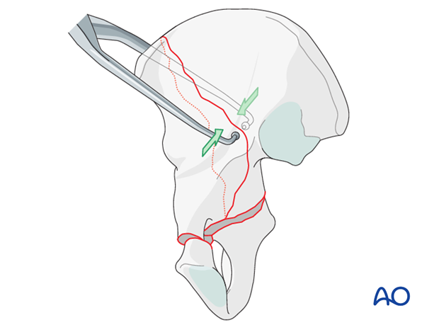 orif through ilioinguinal approach